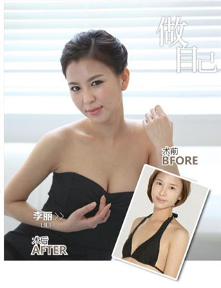昆明假體豐胸價格受什么影響，效果怎么樣