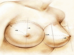 沈陽(yáng)做乳頭縮小術(shù)前要注意什么問題