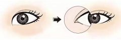 重慶做開(kāi)眼角手術(shù)后要注意哪些問(wèn)題