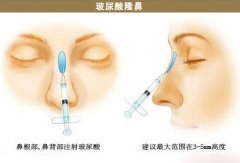 南京玻尿酸隆鼻多少錢一支？彌補(bǔ)美麗缺失