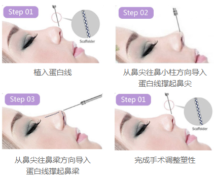 什么人適合做*雕鼻？鼻頭大可以做嗎