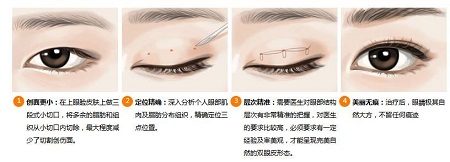 韓式微創(chuàng)雙眼皮多少錢(qián)