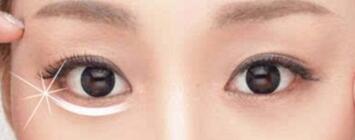 去眼袋