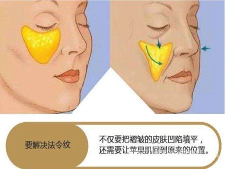 脂肪填充法令紋能維持多少時間？