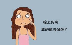 深圳激光祛斑后還會反彈？