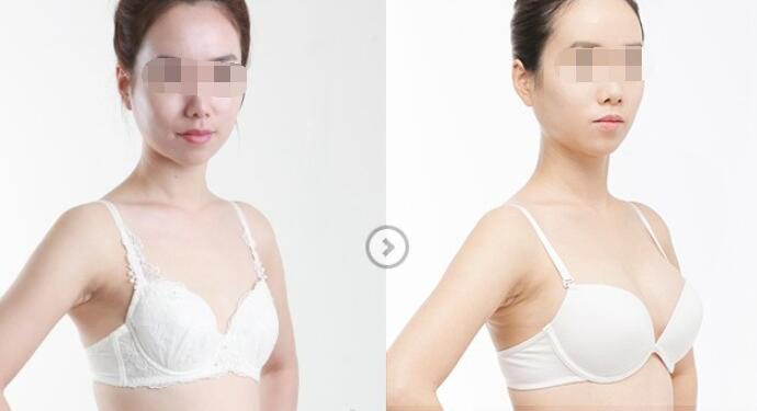 假體隆胸能夠維持多長的時間？要如何護(hù)理？