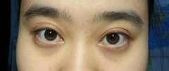 黑眼圈怎么消除？