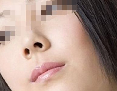 矯正鼻孔大的手術(shù)會(huì)留疤嗎？
