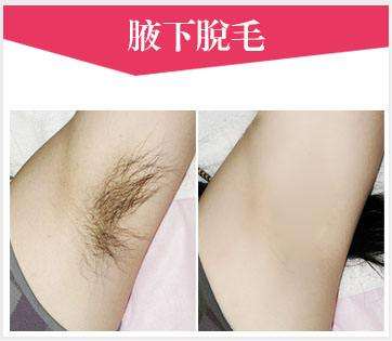 美萊冰點(diǎn)脫毛效果怎么樣？