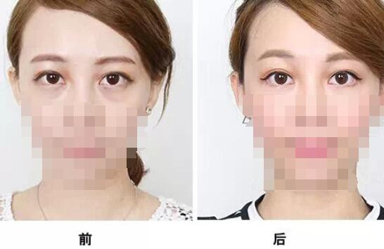 天津超聲法去眼袋多少錢？