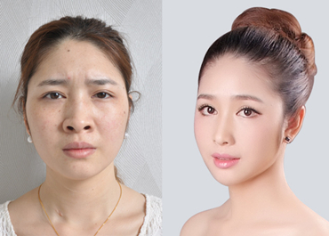 深圳假體隆鼻整形費用多少錢？
