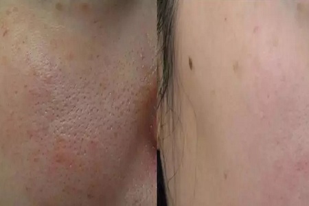 激光縮毛孔