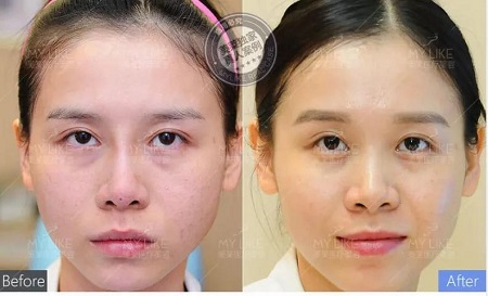 水光、紋眉