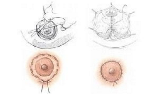 乳暈再造術(shù)價(jià)格是多少？