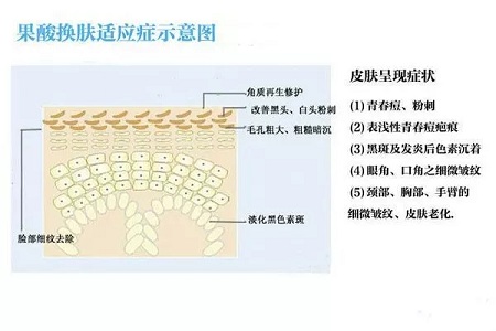 擠痘竟然被送進ICU！你的痘痘還好嗎？