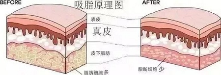 醫(yī)美白皮書：吸脂等于減肥嗎？