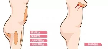 自體脂肪or假體隆胸，我到底應(yīng)該怎么選？