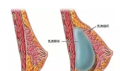 自體脂肪or假體隆胸，我到底應(yīng)該怎么選？