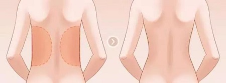 吸脂