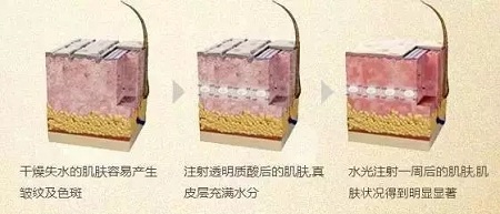 水光，打1次和4次究竟有多大區(qū)別？