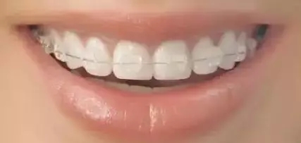 問診室：關(guān)于正畸，不止你想的這么簡單喔