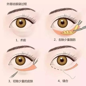 還把眼袋當臥蠶？那就別怪小弟弟喊你阿姨了