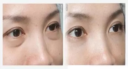 還把眼袋當臥蠶？那就別怪小弟弟喊你阿姨了