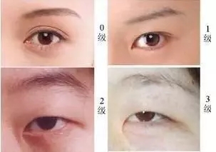 美萊實(shí)驗(yàn)室：開眼角就是醫(yī)師想多收錢？