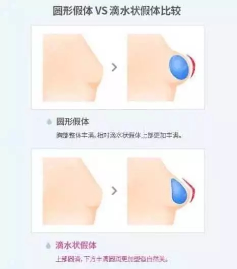 [我問大醫(yī)師]隆乳手術(shù)問題，你想要的答案，這里都有