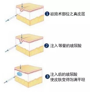 用玻尿酸治療鼻唇溝，一定要注意這種情況！