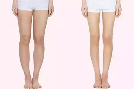 問診室 | 大腿吸脂后多久可以運(yùn)動(dòng)？