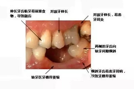 牙齒缺失時，選烤瓷牙還是那種？