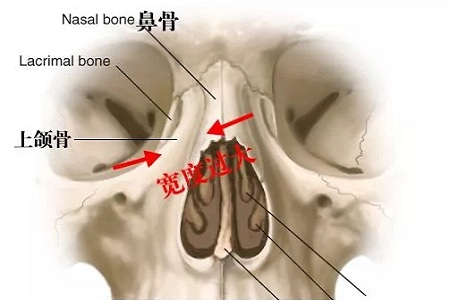 側(cè)面看鼻梁不矮,正面看鼻子卻很塌是什么原因？