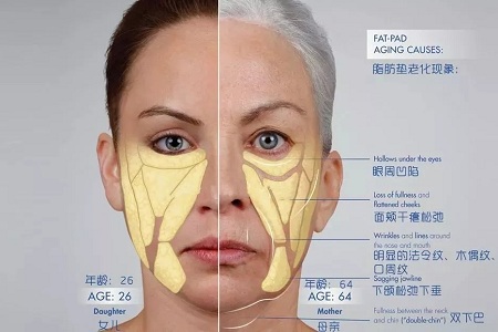 皺紋、松垂、凹陷，三大衰老癥狀，怎么解決？