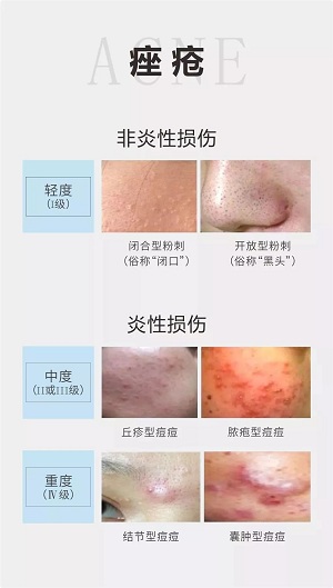 痤瘡分為粉刺和毛囊炎兩大類(lèi)，按輕重程度分成四個(gè)等級(jí)