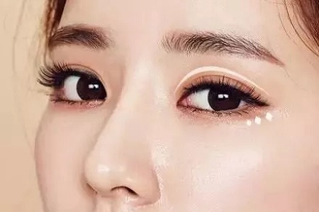 做雙眼皮，為什么醫(yī)生建議做開(kāi)眼角