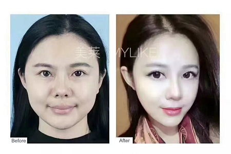 想抗衰，提升和玻尿酸哪個(gè)更適合？