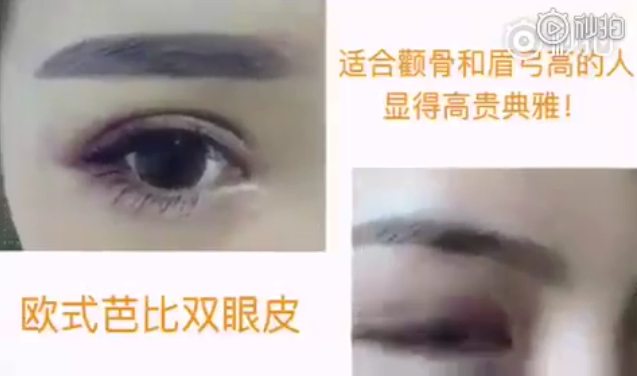 武漢美萊歐式雙眼皮，雖然好看但不是每個(gè)人都適合的