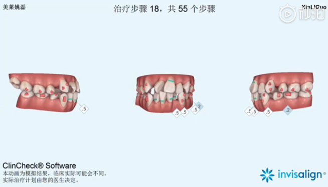 南京美萊口腔全景側(cè)位片，拍照取模，動(dòng)畫方案設(shè)計(jì)