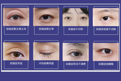<a href='/zz/' target='_blank'><u>鄭州美萊</u></a>雙眼皮修復(fù)為什么比割雙眼皮貴？