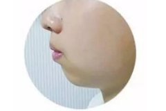 下巴短小后縮怎么辦，重慶整形醫(yī)院墊下巴效果好嗎