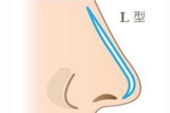 假體隆鼻失敗修復(fù)需要花費(fèi)多少錢,手術(shù)失敗率高嗎