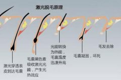 蘇州脫毛醫(yī)院做冰點(diǎn)脫毛的價(jià)格多少，對(duì)身體有沒有傷害