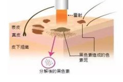 西安整形醫(yī)院做點陣激光多少錢，一次有效果嗎