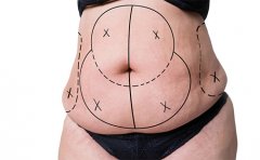 腰腹吸脂對身體有害嗎，腰腹環(huán)吸抽脂需要多久恢復(fù)期