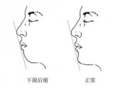 怎樣判斷下巴是否短縮，重慶整形醫(yī)院做矯正手術(shù)多少錢