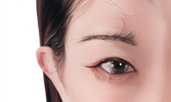 天生的上瞼下垂做手術(shù)矯正要多少錢(qián)，效果自然嗎